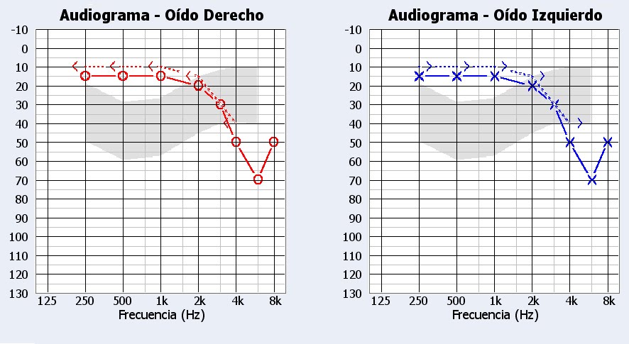 hipoacusia inducida por ruido